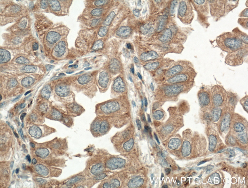 Immunohistochemistry (IHC) staining of human lung cancer tissue using TPSD1 Polyclonal antibody (55239-1-AP)
