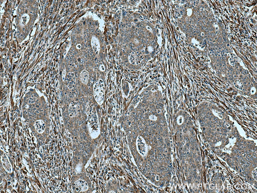 Immunohistochemistry (IHC) staining of human colon cancer tissue using TPST1 Polyclonal antibody (12404-1-AP)