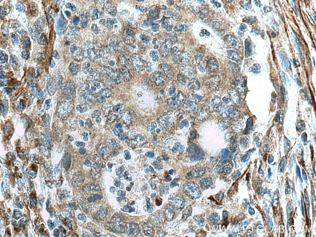 Immunohistochemistry (IHC) staining of human colon cancer tissue using TPST1 Polyclonal antibody (12404-1-AP)