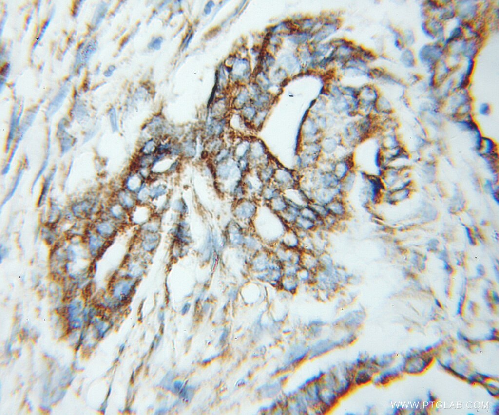 Immunohistochemistry (IHC) staining of human pancreas cancer tissue using TPST2 Polyclonal antibody (11699-1-AP)