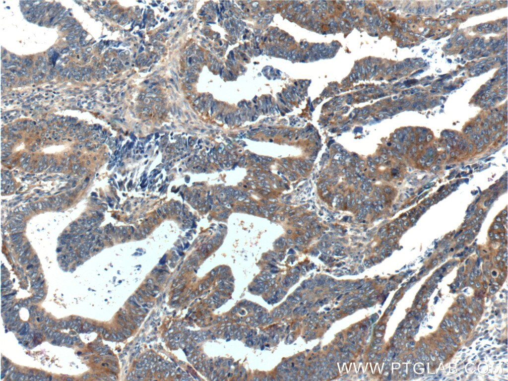 Immunohistochemistry (IHC) staining of human colon cancer tissue using TPT1 Polyclonal antibody (10824-1-AP)