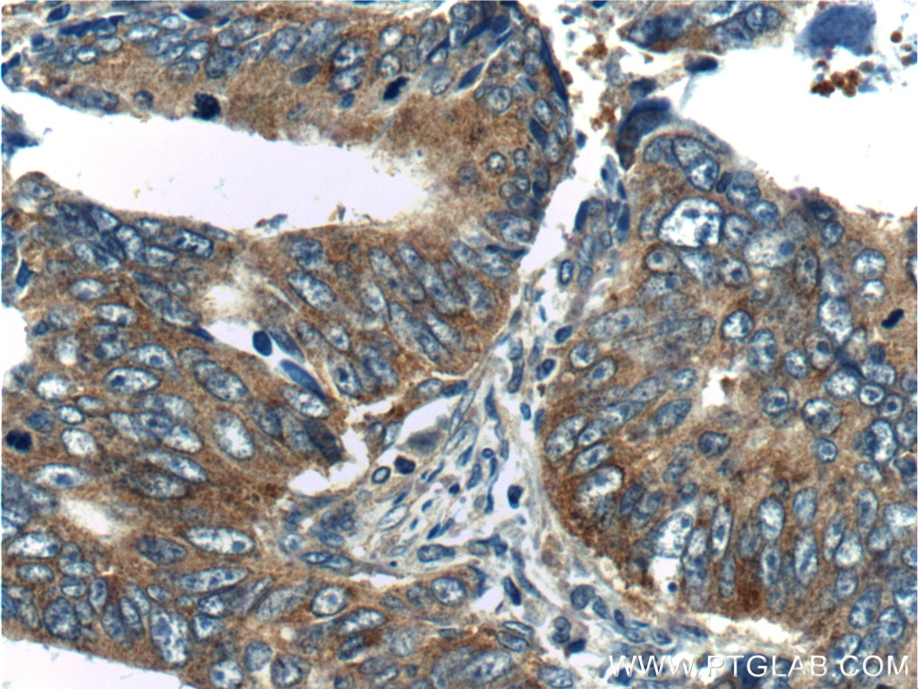 Immunohistochemistry (IHC) staining of human colon cancer tissue using TPT1 Polyclonal antibody (10824-1-AP)