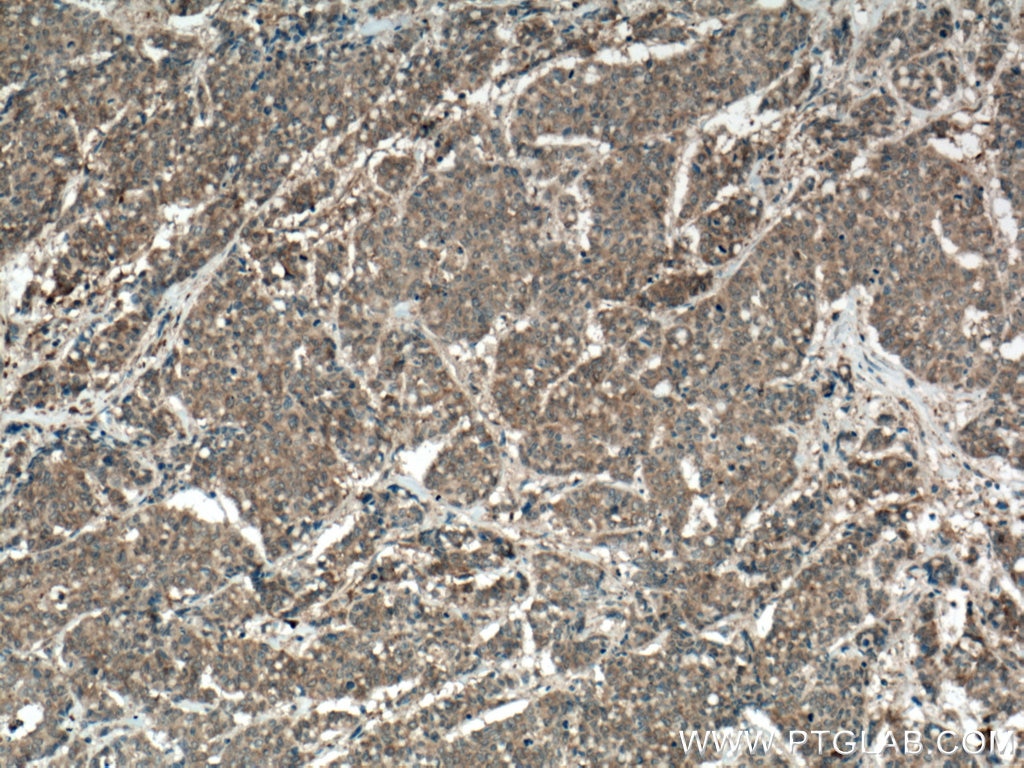 Immunohistochemistry (IHC) staining of human colon cancer tissue using TPT1 Monoclonal antibody (66713-1-Ig)