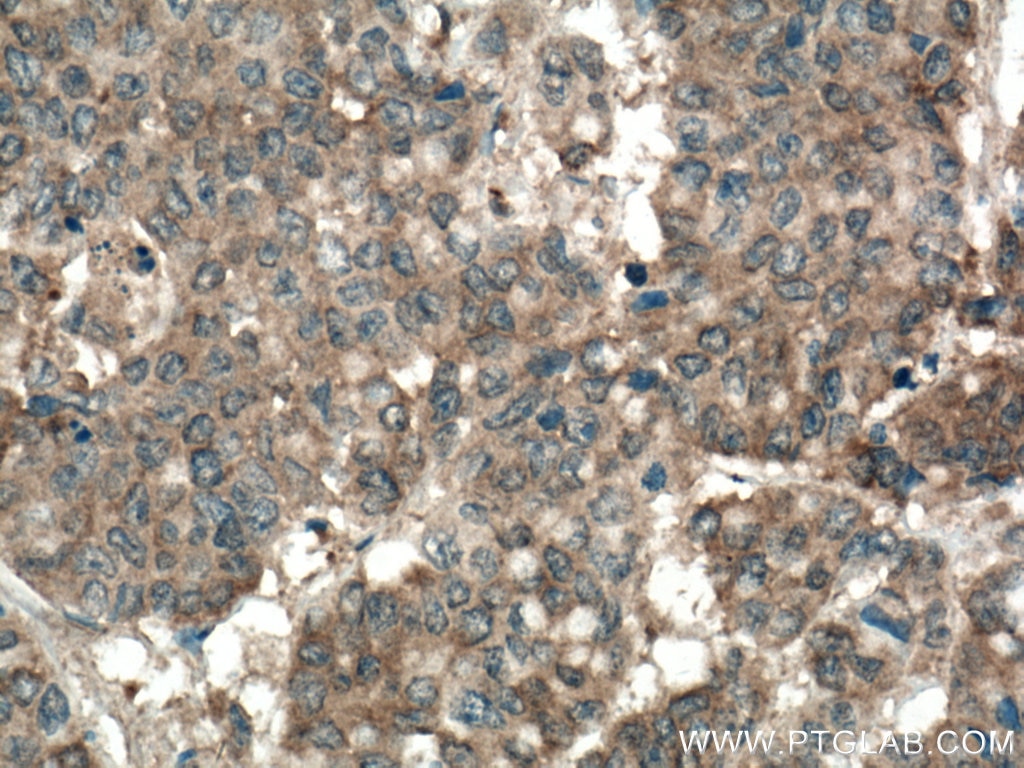 Immunohistochemistry (IHC) staining of human colon cancer tissue using TPT1 Monoclonal antibody (66713-1-Ig)