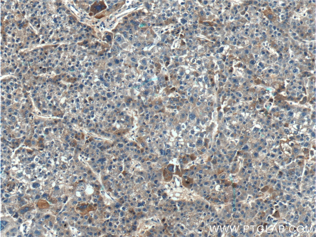 Immunohistochemistry (IHC) staining of human liver cancer tissue using TPTE2 Polyclonal antibody (25120-1-AP)