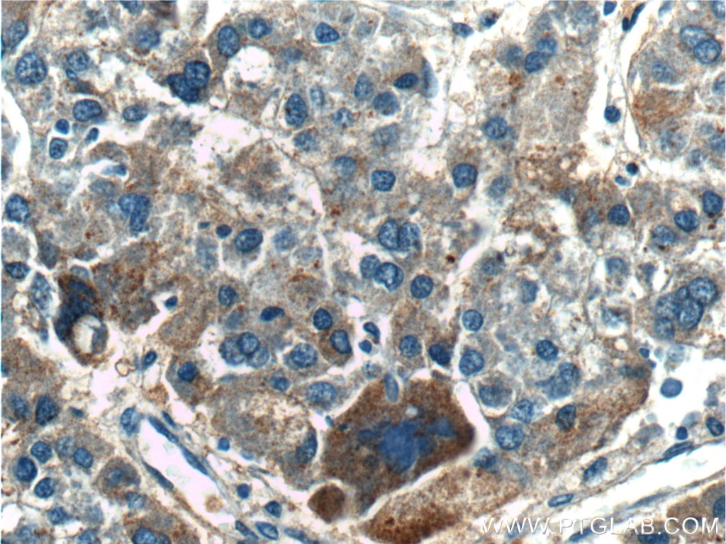 Immunohistochemistry (IHC) staining of human liver cancer tissue using TPTE2 Polyclonal antibody (25120-1-AP)