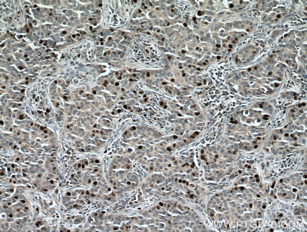 Immunohistochemistry (IHC) staining of human breast cancer tissue using TPX2 Polyclonal antibody (11741-1-AP)