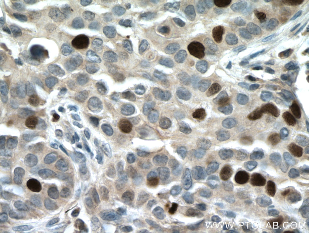 Immunohistochemistry (IHC) staining of human breast cancer tissue using TPX2 Polyclonal antibody (11741-1-AP)