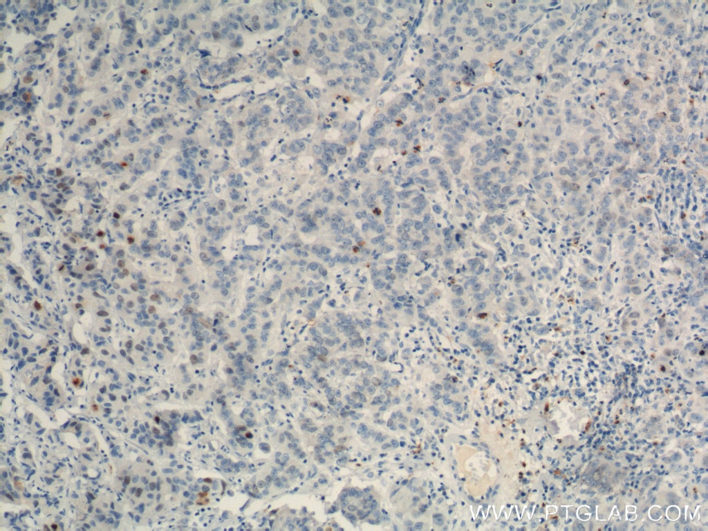 Immunohistochemistry (IHC) staining of human prostate cancer tissue using TPX2 Polyclonal antibody (11741-1-AP)
