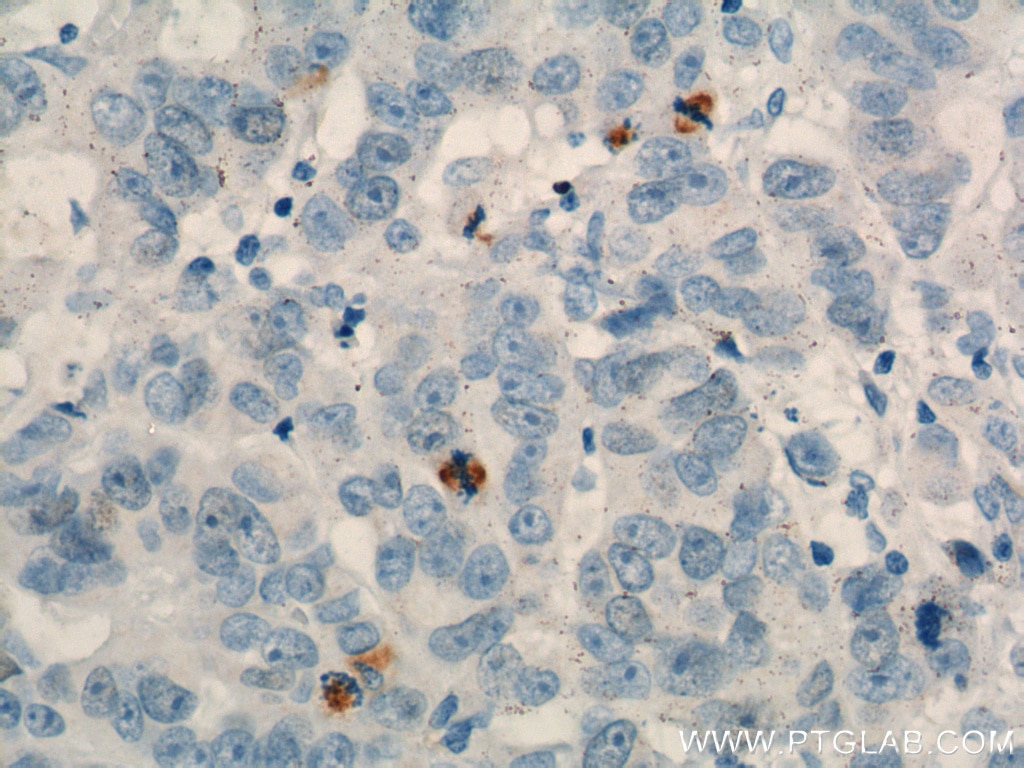 Immunohistochemistry (IHC) staining of human prostate cancer tissue using TPX2 Polyclonal antibody (11741-1-AP)