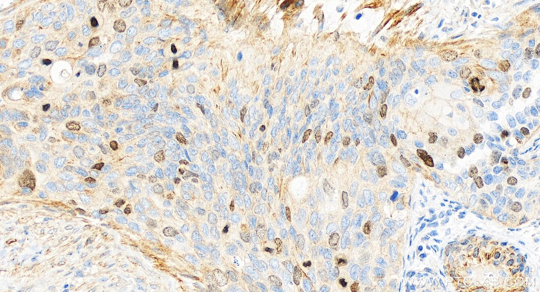 Immunohistochemistry (IHC) staining of human cervical cancer tissue using TPX2 Recombinant antibody (85118-6-RR)