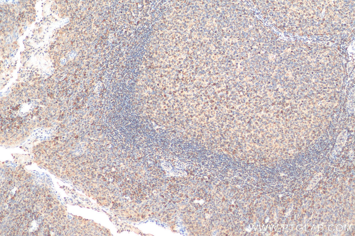 Immunohistochemistry (IHC) staining of human tonsillitis tissue using TRA Polyclonal antibody (11890-1-AP)