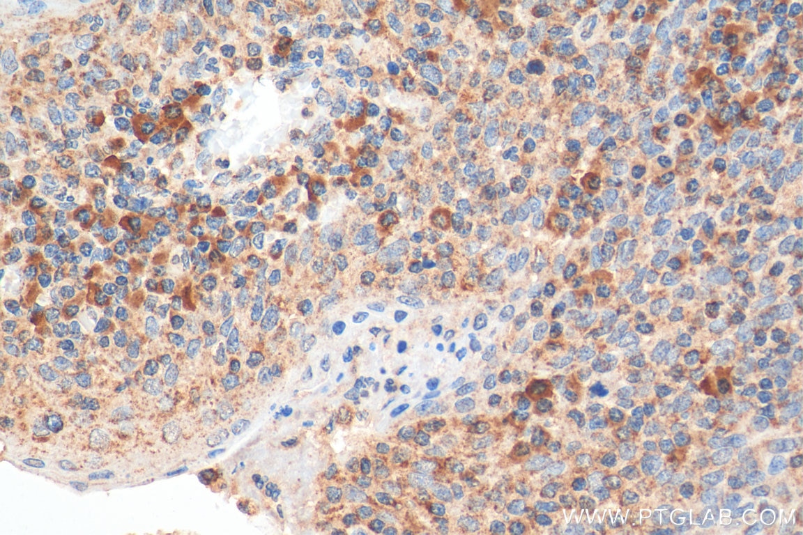 Immunohistochemistry (IHC) staining of human tonsillitis tissue using TRA Polyclonal antibody (11890-1-AP)