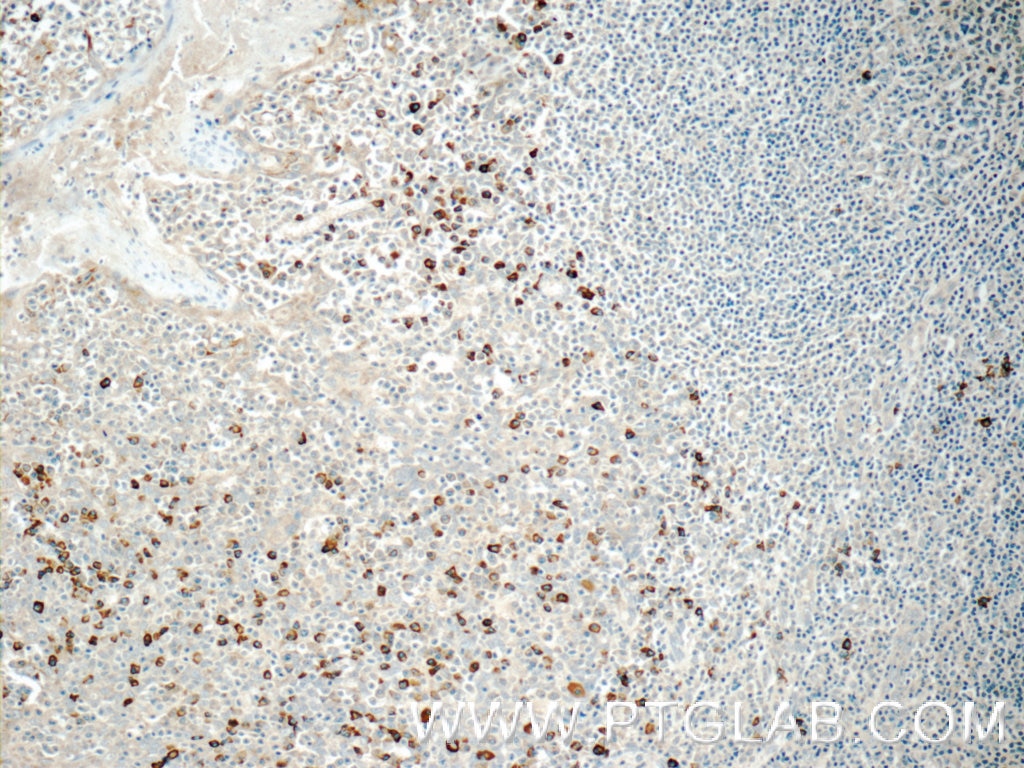 Immunohistochemistry (IHC) staining of human tonsillitis tissue using TRA Polyclonal antibody (11890-1-AP)