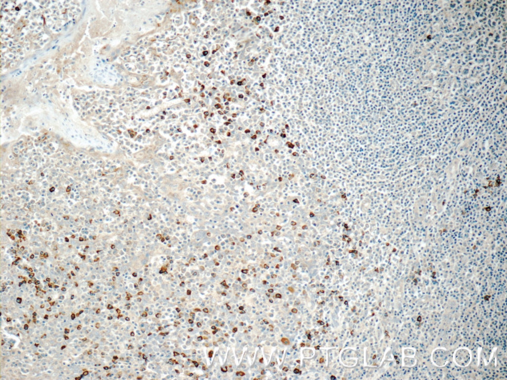 Immunohistochemistry (IHC) staining of human tonsillitis tissue using TRA Polyclonal antibody (11890-1-AP)