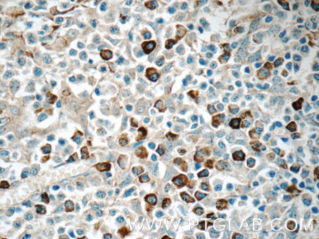 Immunohistochemistry (IHC) staining of human tonsillitis tissue using TRA Polyclonal antibody (11890-1-AP)