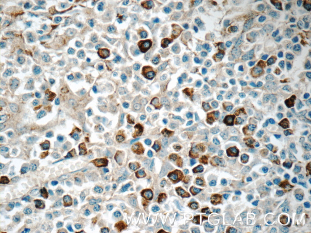 IHC staining of human tonsillitis using 11890-1-AP