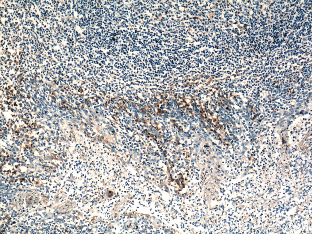 IHC staining of human tonsillitis using 26845-1-AP