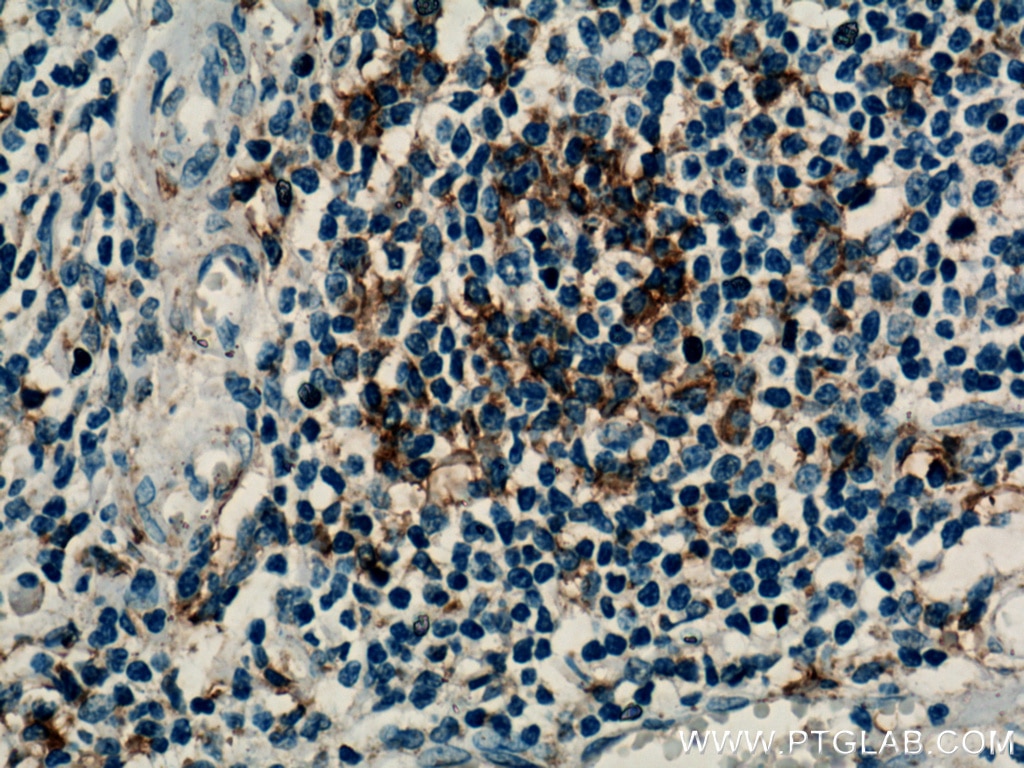 IHC staining of human tonsillitis using 26845-1-AP