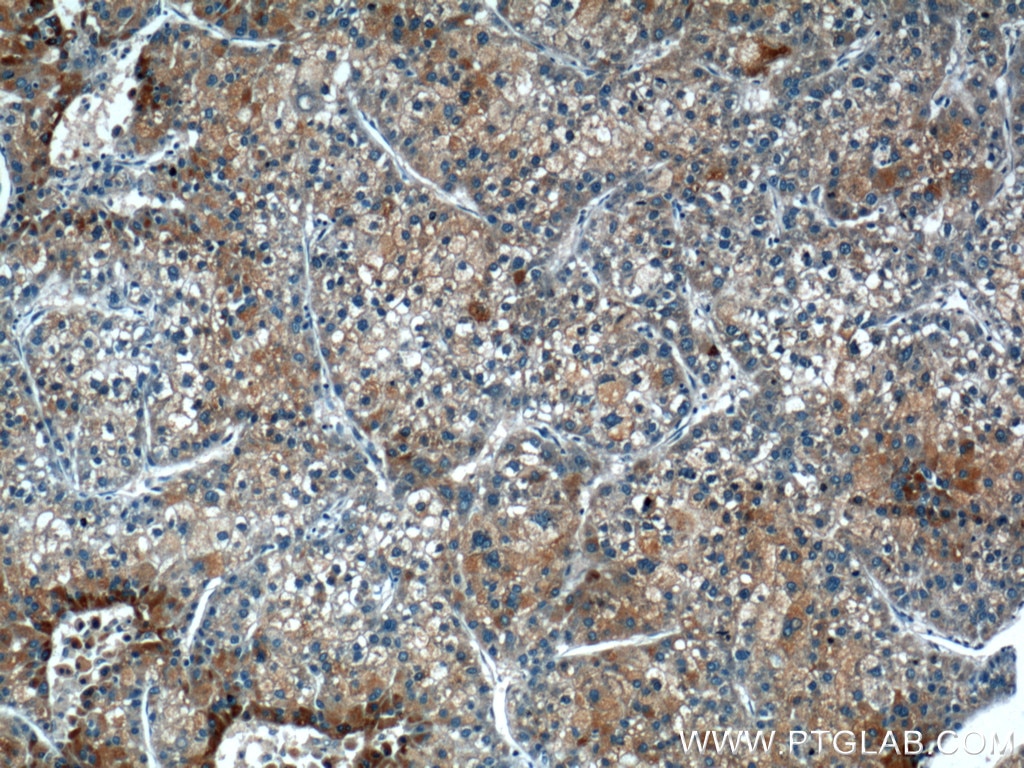 Immunohistochemistry (IHC) staining of human liver cancer tissue using TRAF2 Polyclonal antibody (26846-1-AP)