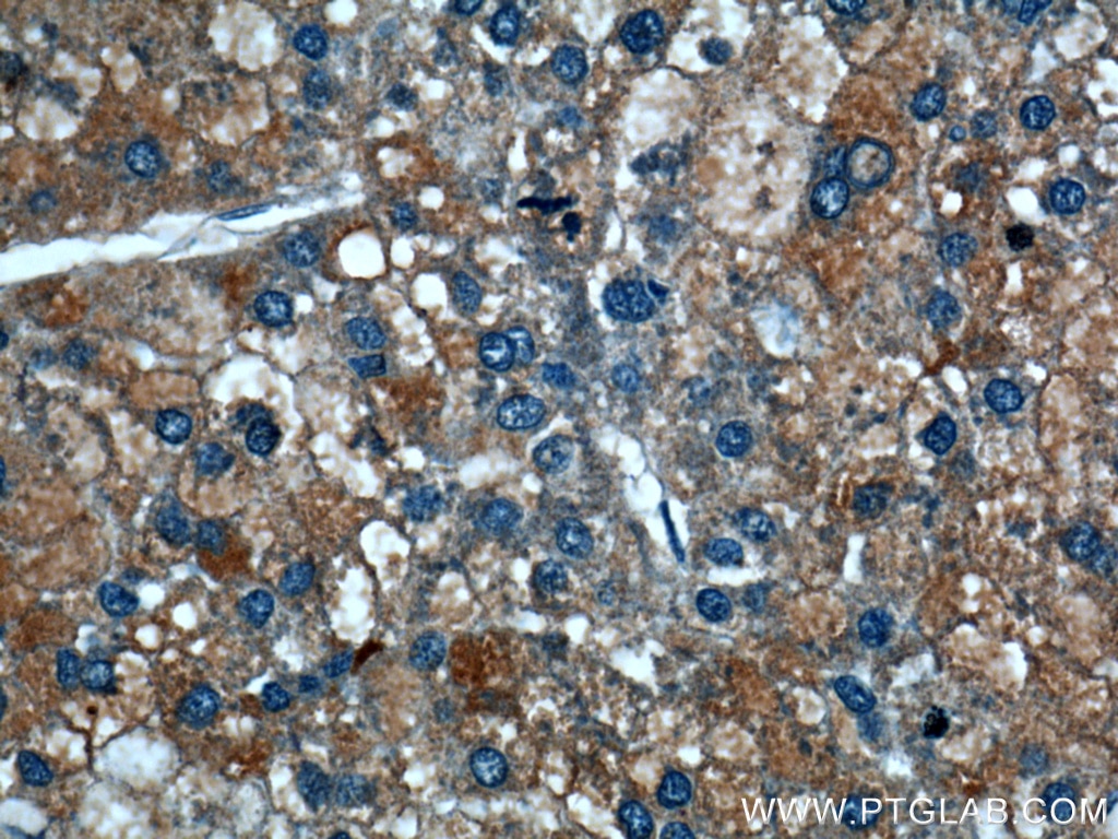 Immunohistochemistry (IHC) staining of human liver cancer tissue using TRAF2 Polyclonal antibody (26846-1-AP)