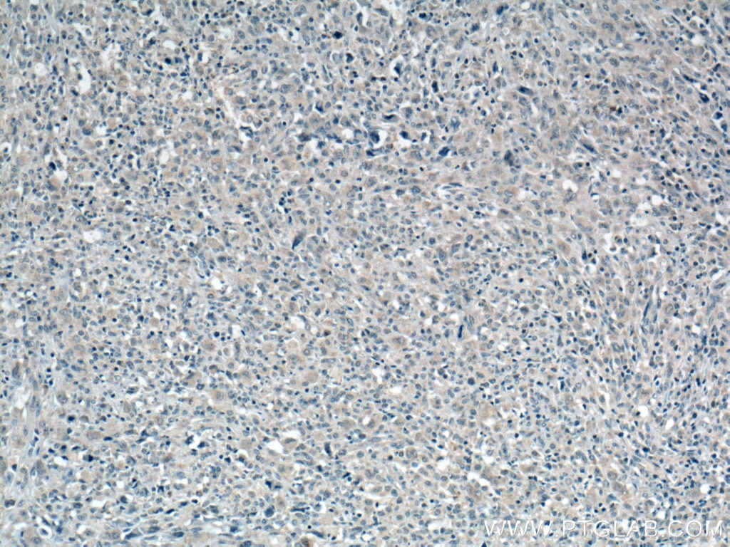 Immunohistochemistry (IHC) staining of human lymphoma tissue using TRAF3 Monoclonal antibody (66310-1-Ig)