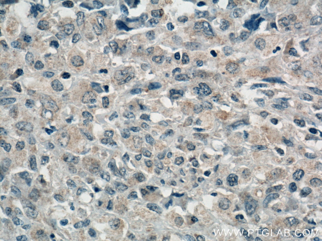 Immunohistochemistry (IHC) staining of human lymphoma tissue using TRAF3 Monoclonal antibody (66310-1-Ig)