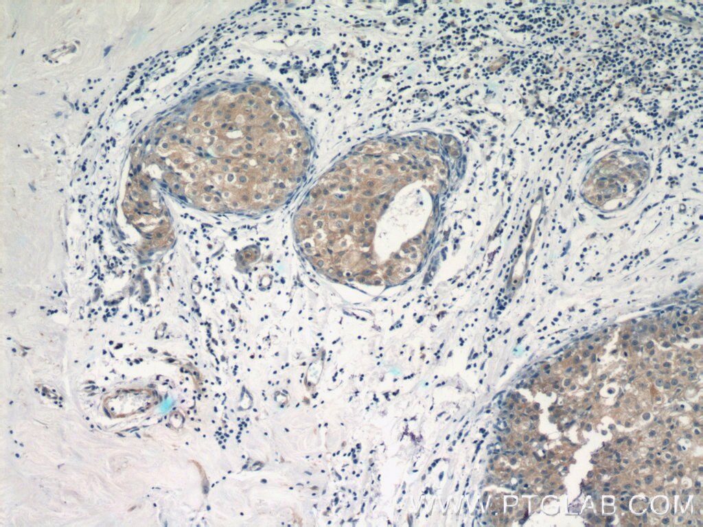 Immunohistochemistry (IHC) staining of human breast cancer tissue using TRAF3IP1 Polyclonal antibody (14404-1-AP)