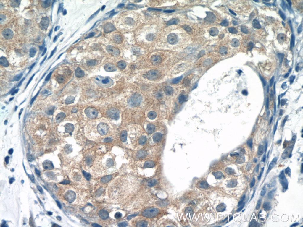 Immunohistochemistry (IHC) staining of human breast cancer tissue using TRAF3IP1 Polyclonal antibody (14404-1-AP)