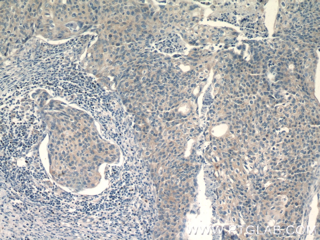 Immunohistochemistry (IHC) staining of human cervical cancer tissue using TRAF3IP1 Polyclonal antibody (14404-1-AP)
