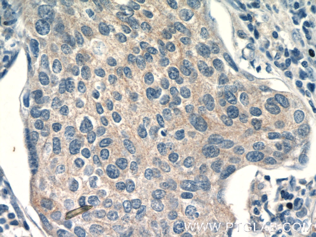 Immunohistochemistry (IHC) staining of human cervical cancer tissue using TRAF3IP1 Polyclonal antibody (14404-1-AP)