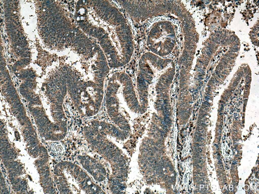 Immunohistochemistry (IHC) staining of human colon cancer tissue using TRAF3IP3 Polyclonal antibody (18110-1-AP)