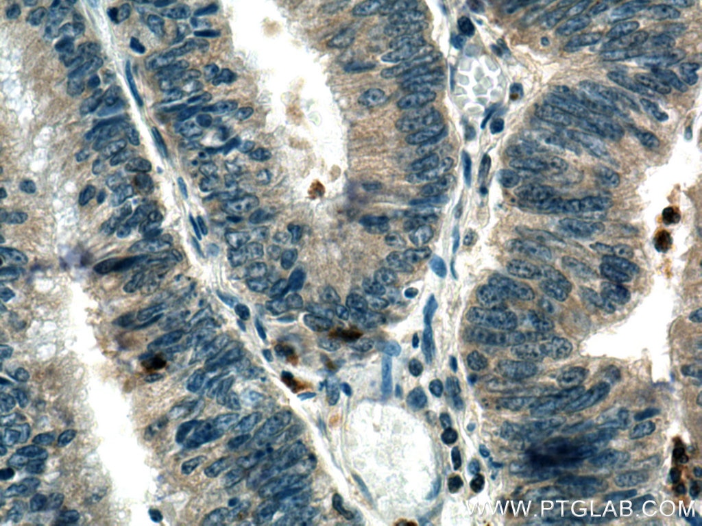 Immunohistochemistry (IHC) staining of human colon cancer tissue using TRAF3IP3 Polyclonal antibody (18110-1-AP)