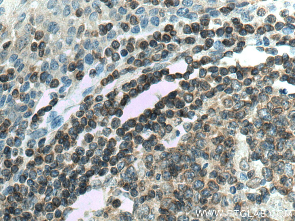 Immunohistochemistry (IHC) staining of human tonsillitis tissue using TRAF3IP3 Polyclonal antibody (18110-1-AP)
