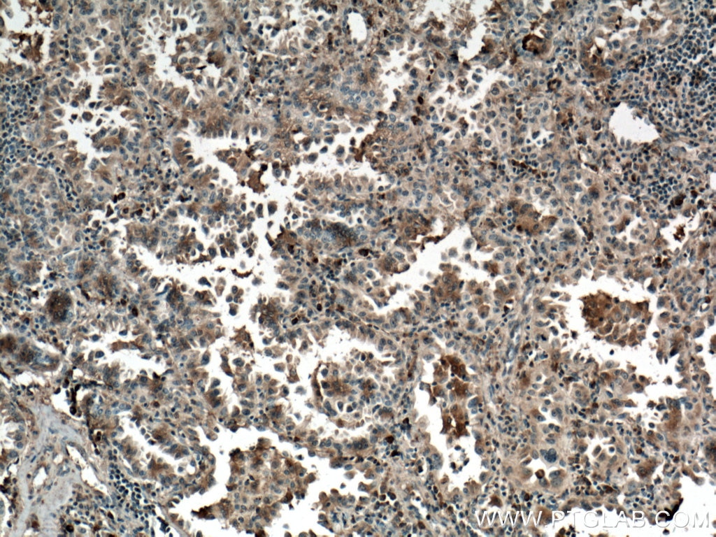 Immunohistochemistry (IHC) staining of human lung cancer tissue using TRAF4 Monoclonal antibody (66755-1-Ig)