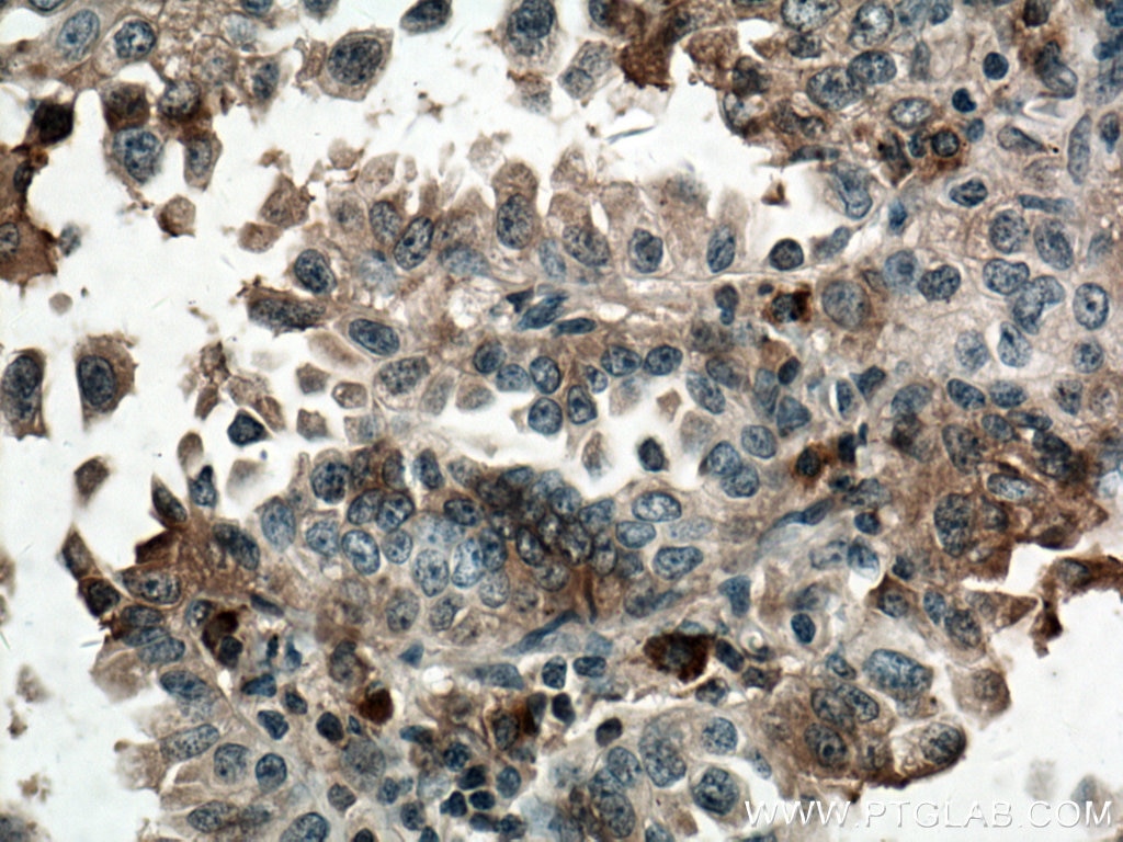 Immunohistochemistry (IHC) staining of human lung cancer tissue using TRAF4 Monoclonal antibody (66755-1-Ig)
