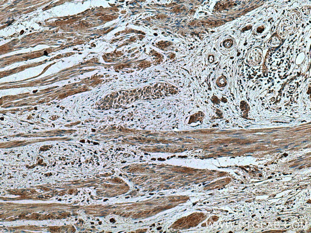 Immunohistochemistry (IHC) staining of human urothelial carcinoma tissue using TRAF4 Monoclonal antibody (66755-1-Ig)