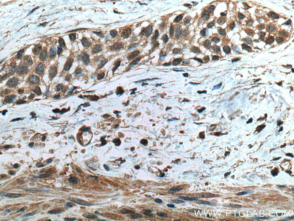 Immunohistochemistry (IHC) staining of human urothelial carcinoma tissue using TRAF4 Monoclonal antibody (66755-1-Ig)