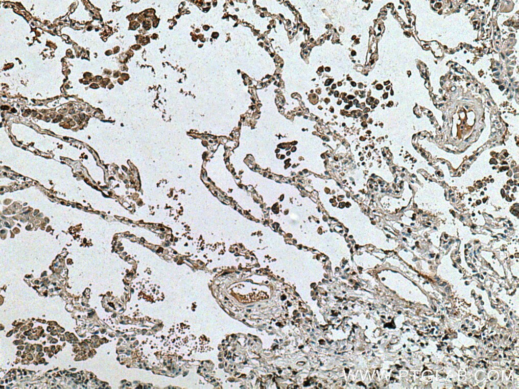 Immunohistochemistry (IHC) staining of human lung cancer tissue using TRAF4 Monoclonal antibody (66755-1-Ig)