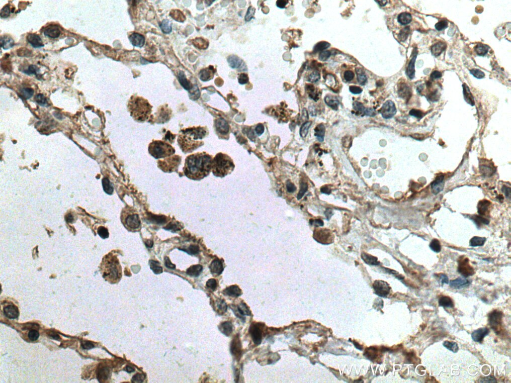 Immunohistochemistry (IHC) staining of human lung cancer tissue using TRAF4 Monoclonal antibody (66755-1-Ig)