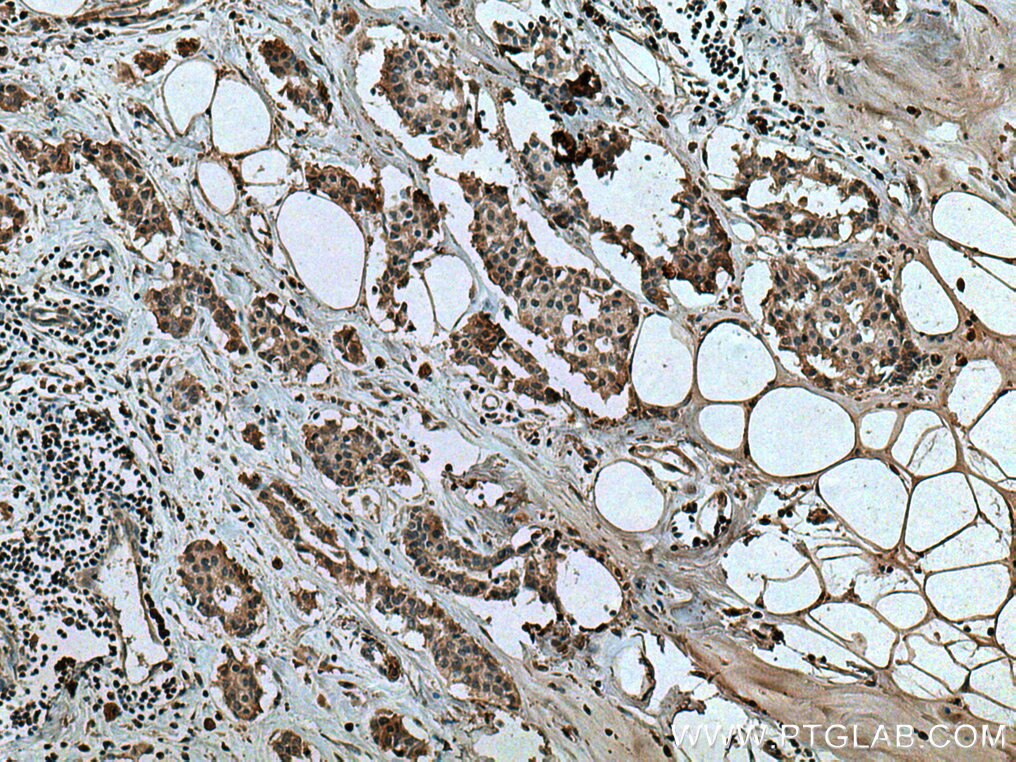 IHC staining of human breast cancer using 66755-1-Ig