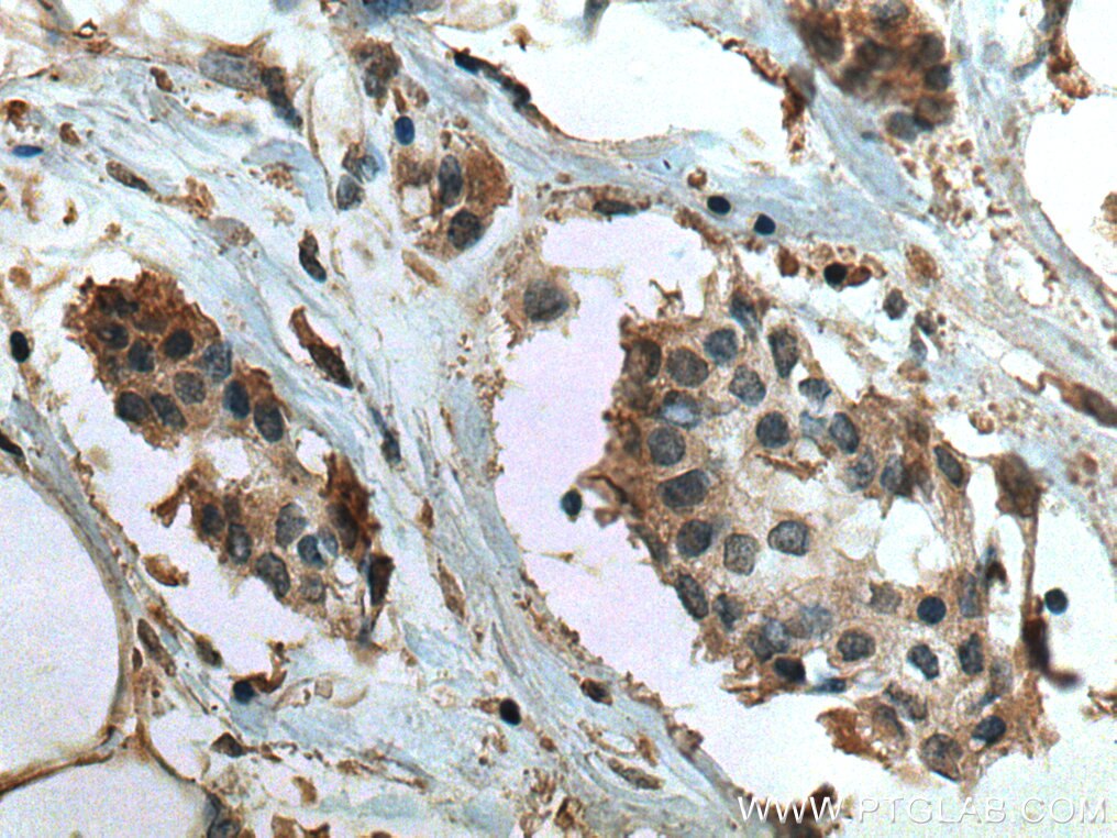 Immunohistochemistry (IHC) staining of human breast cancer tissue using TRAF4 Monoclonal antibody (66755-1-Ig)