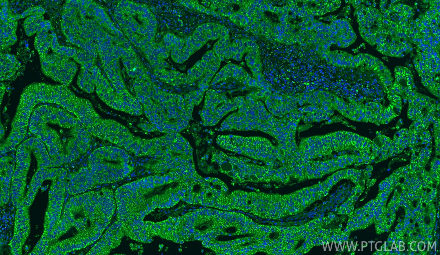 Immunofluorescence (IF) / fluorescent staining of human colon cancer tissue using TRAF7 Polyclonal antibody (11780-1-AP)