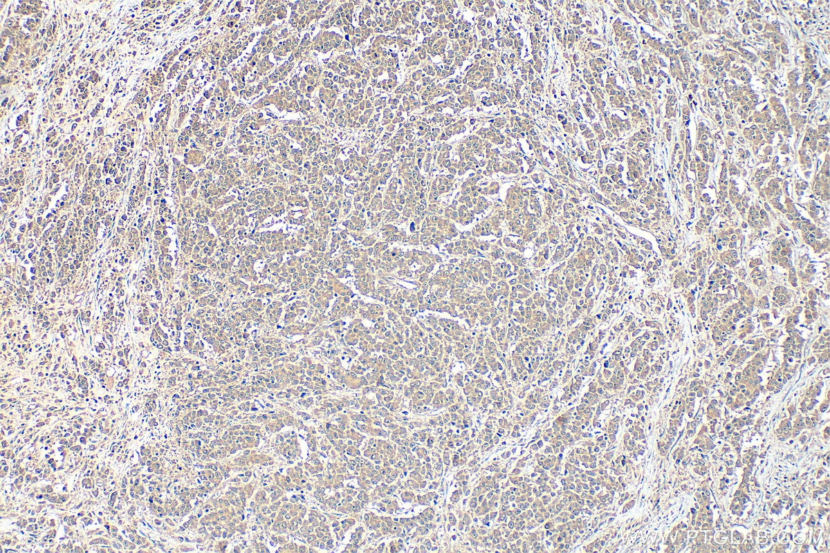 Immunohistochemical analysis of paraffin-embedded human colon cancer tissue slide using 11780-1-AP (TRAF7 antibody) at dilution of 1:600 (under 10x lens). Heat mediated antigen retrieval with Tris-EDTA buffer (pH 9.0). Immunohistochemistry (IHC) staining of human colon cancer tissue using TRAF7 Polyclonal antibody (11780-1-AP)