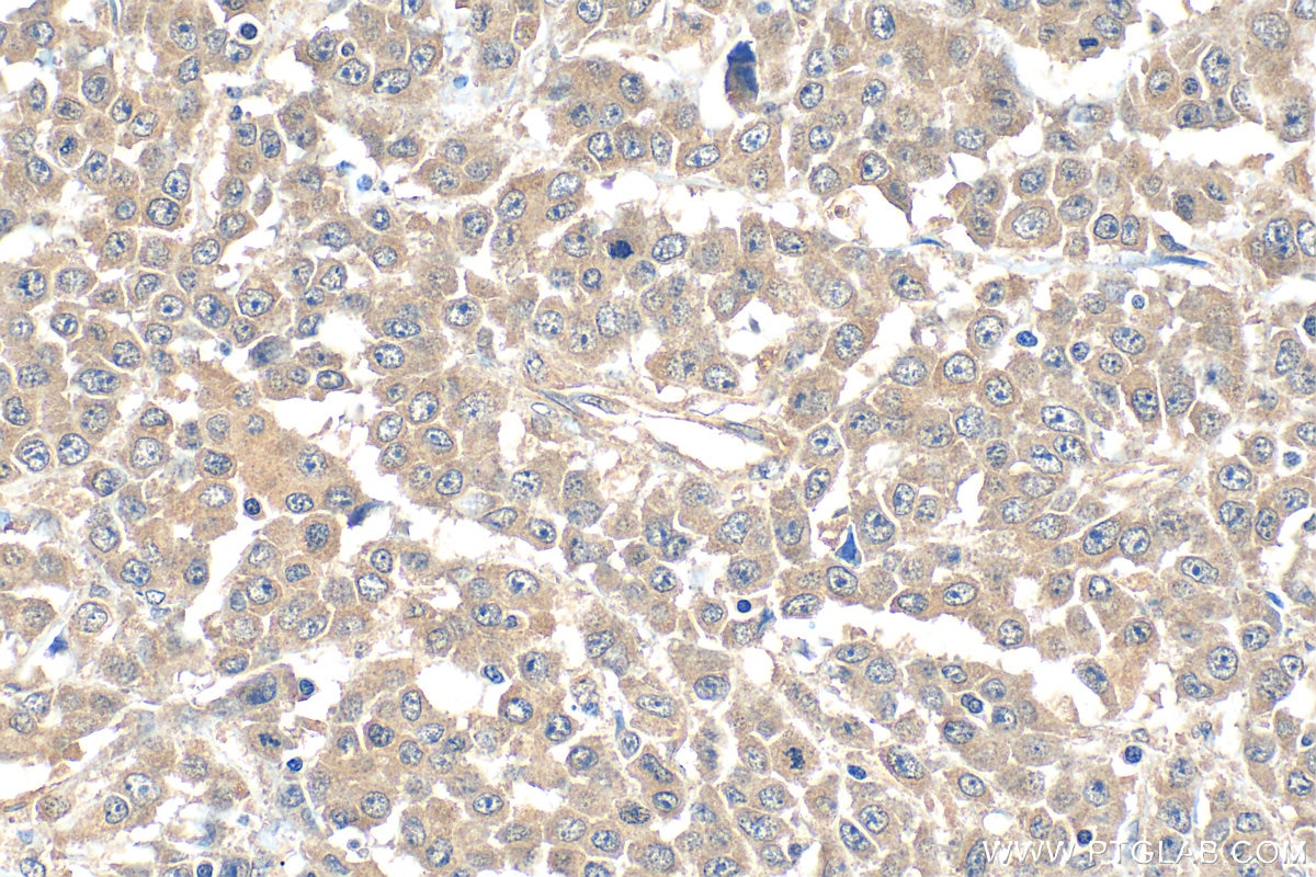 Immunohistochemical analysis of paraffin-embedded human colon cancer tissue slide using 11780-1-AP (TRAF7 antibody) at dilution of 1:600 (under 40x lens). Heat mediated antigen retrieval with Tris-EDTA buffer (pH 9.0). Immunohistochemistry (IHC) staining of human colon cancer tissue using TRAF7 Polyclonal antibody (11780-1-AP)