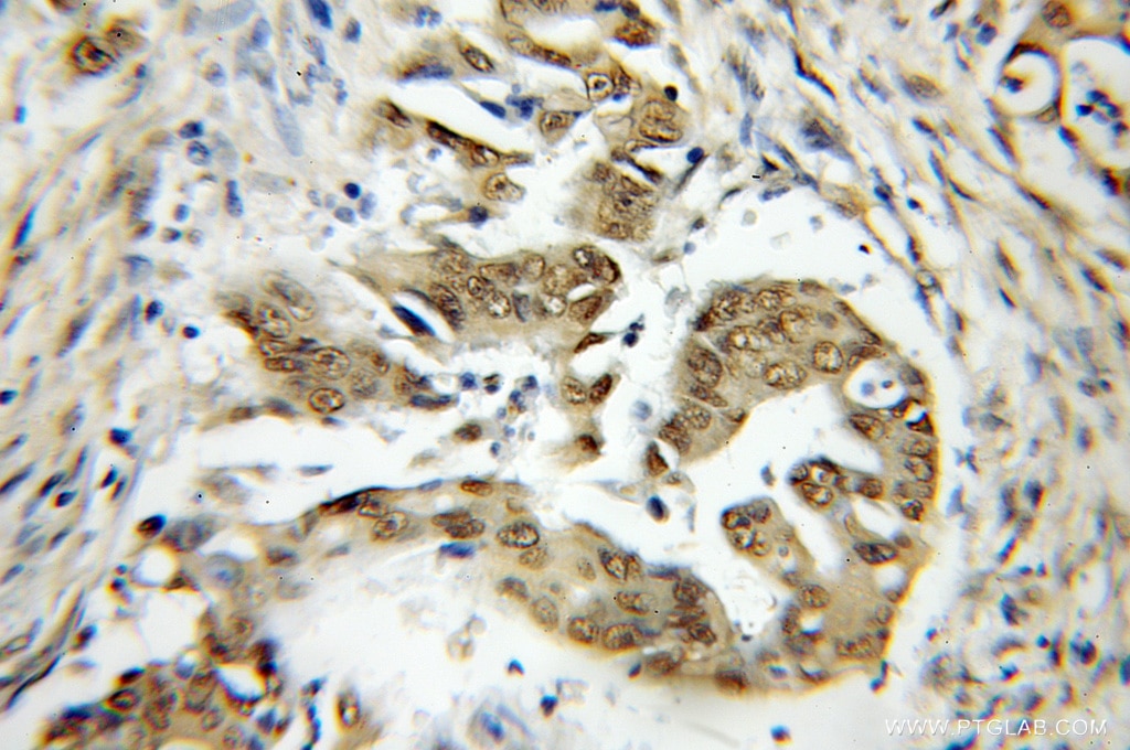 Immunohistochemistry (IHC) staining of human colon cancer tissue using TRAF7 Polyclonal antibody (11780-1-AP)