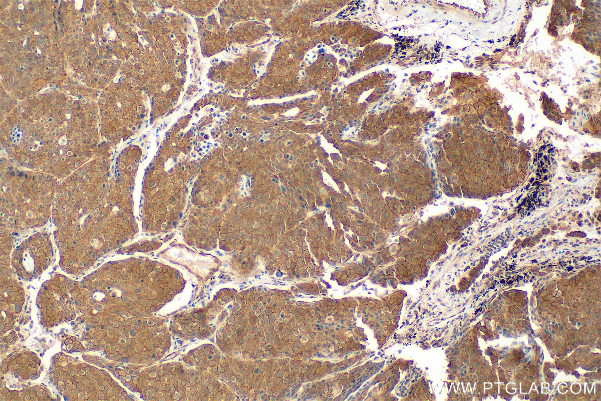 Immunohistochemistry (IHC) staining of human lung cancer tissue using TRAIL/CD253 Polyclonal antibody (27064-1-AP)