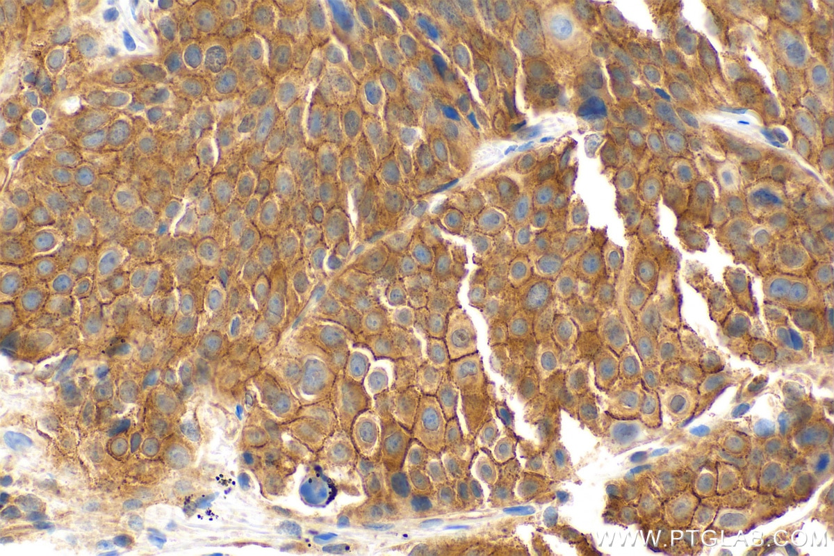 Immunohistochemistry (IHC) staining of human lung cancer tissue using TRAIL/CD253 Polyclonal antibody (27064-1-AP)