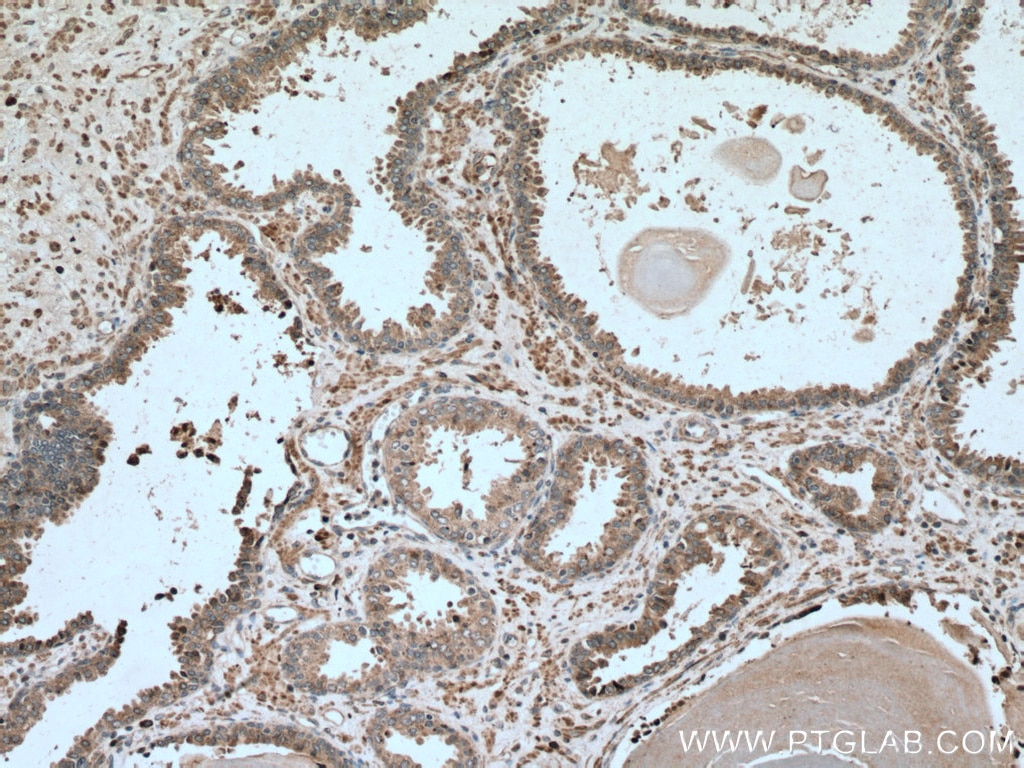 Immunohistochemistry (IHC) staining of human prostate cancer tissue using TRAIL Monoclonal antibody (66756-1-Ig)