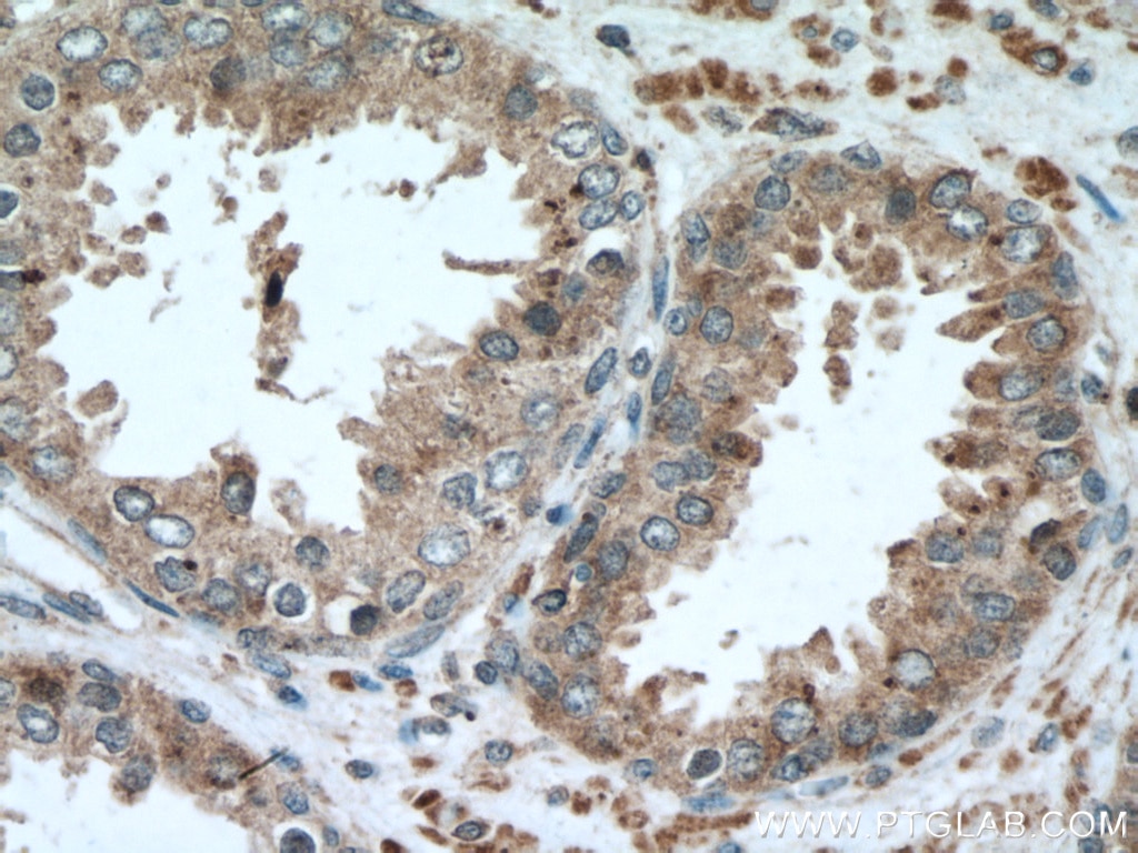 Immunohistochemistry (IHC) staining of human prostate cancer tissue using TRAIL Monoclonal antibody (66756-1-Ig)